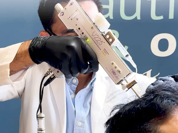 El Dr. Orozco realiza un tratamiento para la caída de cabello en el cuero cabelludo de un paciente